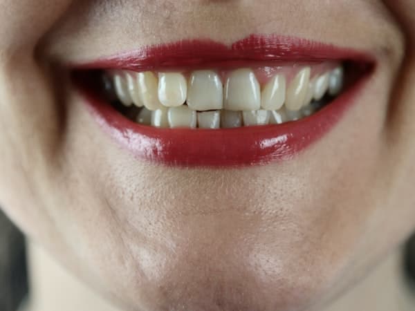 Invisible Aligners result for Preethi