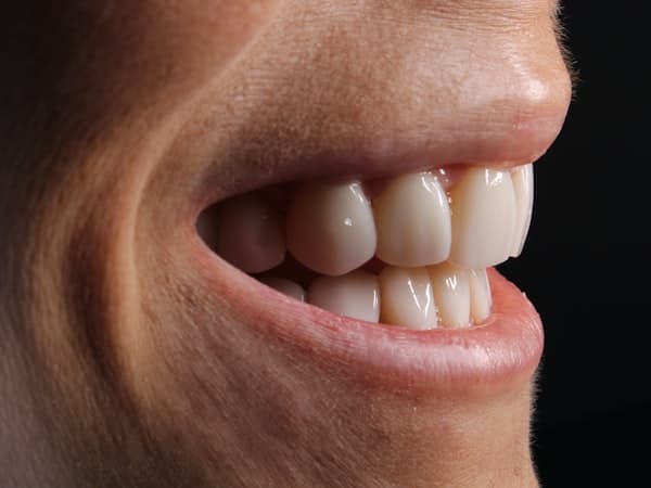 Before - Dental Implants