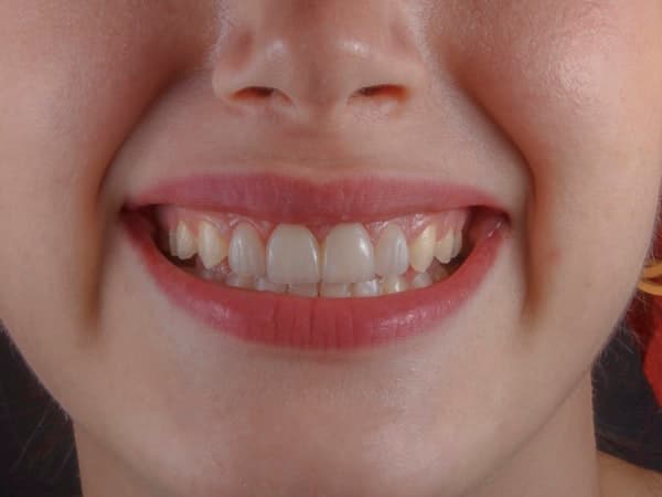 Before - Invisible Aligners