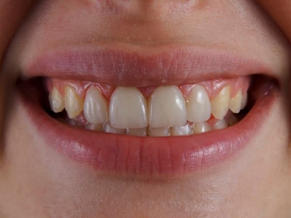 Composite Bonding result for James