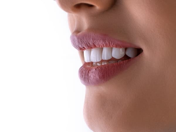 Porcelain Veneers result for Isabelle